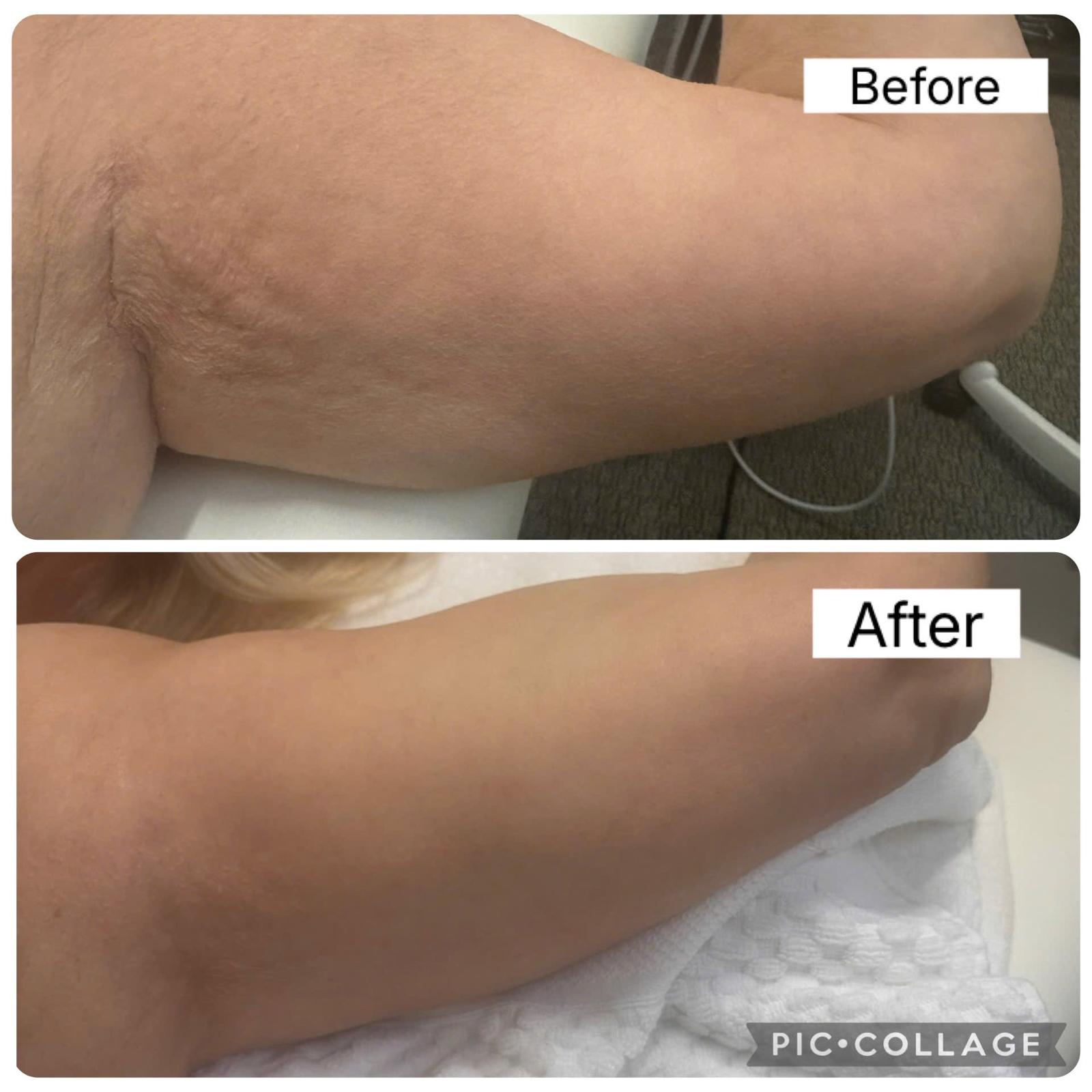 Salmon DNA Microneedling before and after at Wellness by Aesthetica